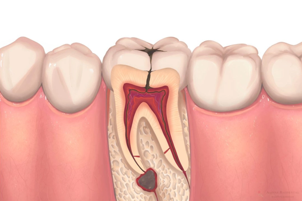 What Happens If You Delay a Root Canal Treatment?